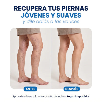 Spray de Crioterapia para Eliminar la Aparición de Varices y Arañitas